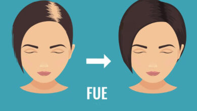 Photo of FUE Hair Transplant in Lahore: Everything You Should Know About It