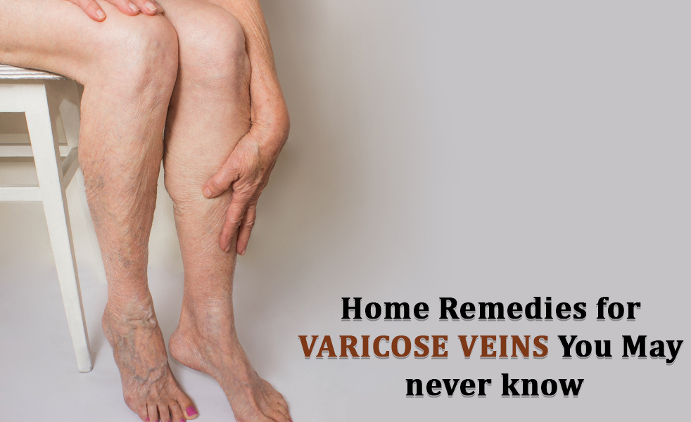 Varicose Veins, himsedpills