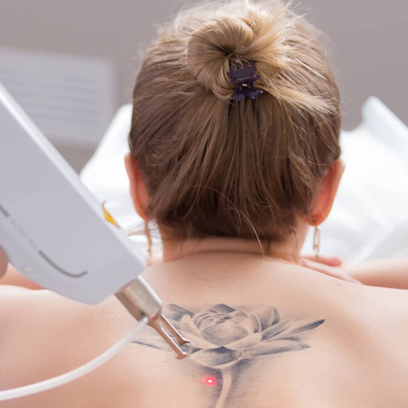 Tattoo Removal Procedure