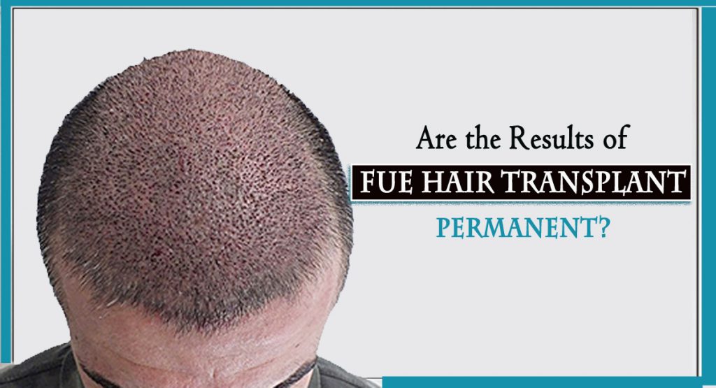 fue hair trasnplant- Are the Results of FUE Hair Transplant Permanent?