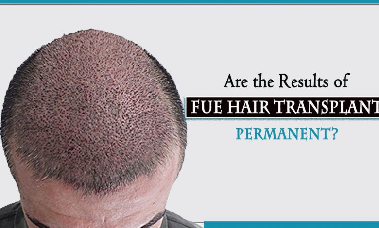 fue hair trasnplant- Are the Results of FUE Hair Transplant Permanent?