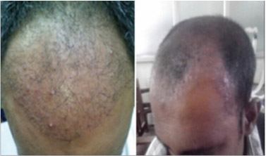 fue hair transplant side effects