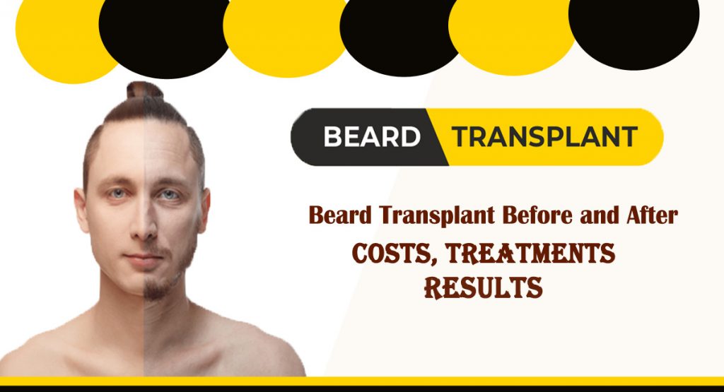 beard transplant- Beard transplant Before and After- Costs, Treatments, and Results