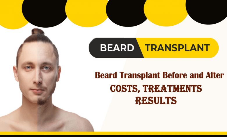 beard transplant- Beard transplant Before and After- Costs, Treatments, and Results