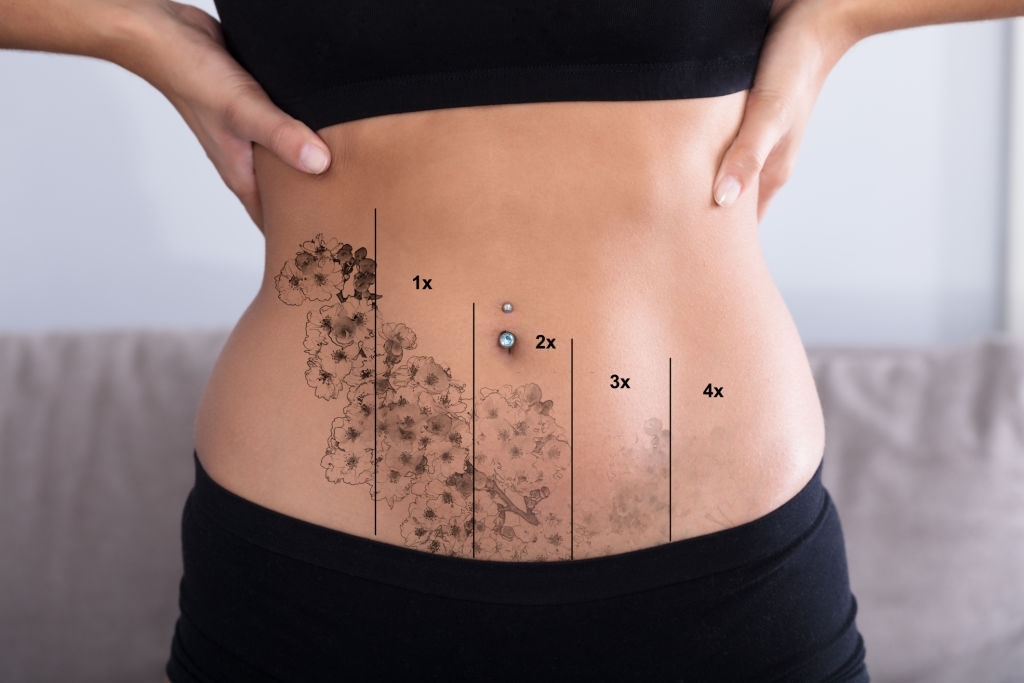 Laser Tattoo Removal