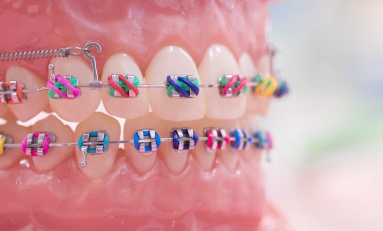 braces colors