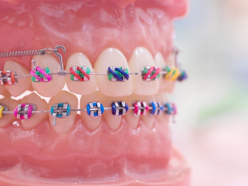 braces colors