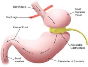 hypno gastric band