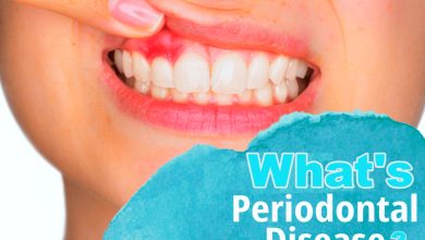 Photo of What’s Periodontal Disease?