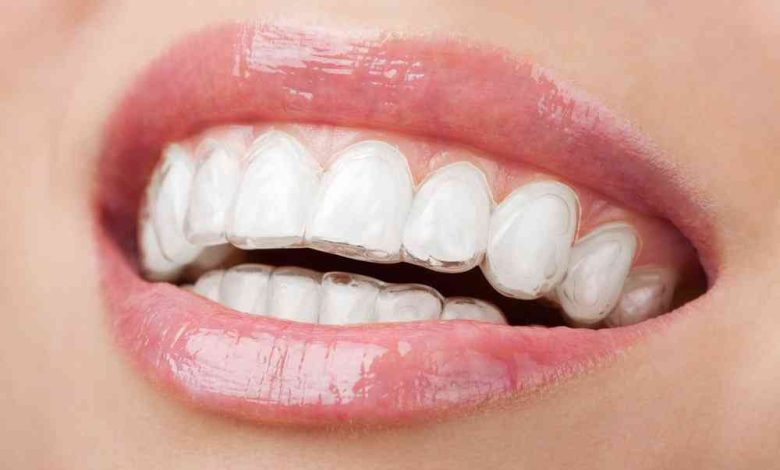 Invisalign